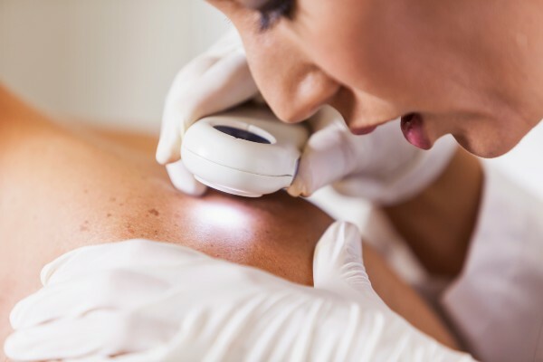 'MyMelanoma' skin cancer study