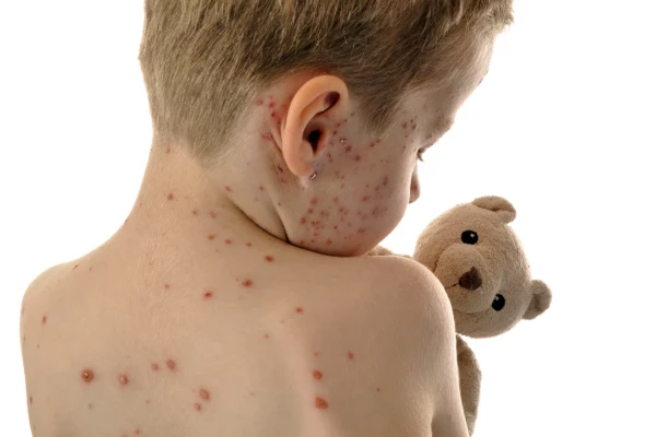 Measles Outbreak